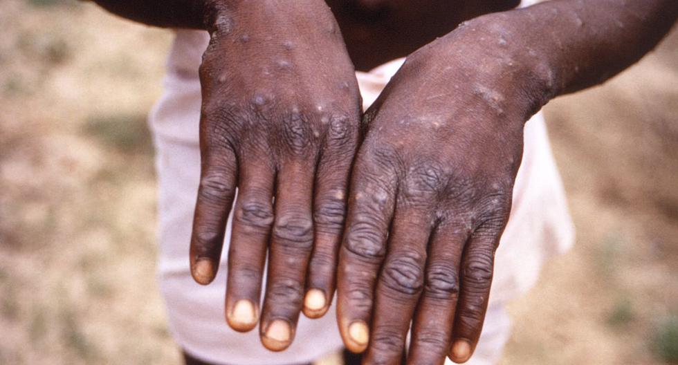 Monkeypox |  Symptoms |  these are the countries that confirmed cases |  NMR |  WORLD