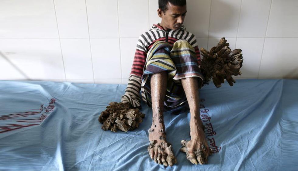 Bangladesh: El 'hombre-árbol' fue 'podado' y ahora luce así. (EFE)
