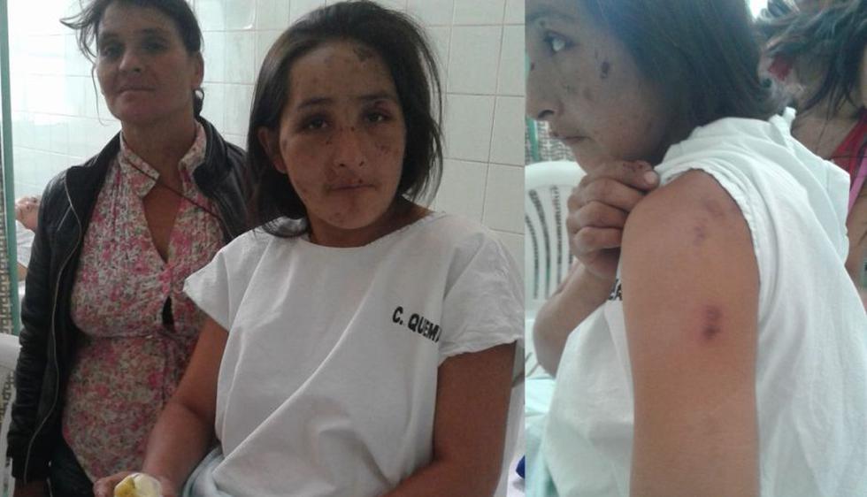 Sujeto ebrio golpeó y quemó a su pareja embarazada porque no le calentó la comida. (Perú21)