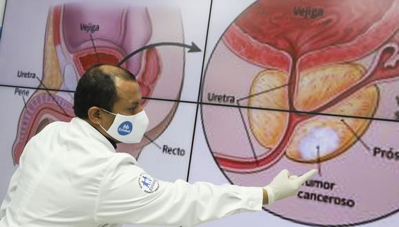 El cáncer de próstata es una enfermedad exclusiva de los hombres, pero sumamente frecuente. Foto: Andina