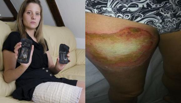 La joven de 18 años sufrió una quemadura en su pierna. (Foto: lematin.ch)