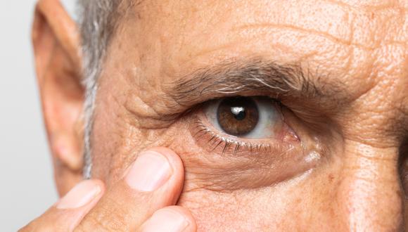 Esta condición se caracteriza por un aumento de la presión intraocular, lo que puede dañar las fibras nerviosas del nervio óptico y provocar una pérdida progresiva del campo visual.