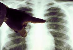Avances tecnológicos contribuyen con diagnósticos precisos en el tratamiento de cáncer de pulmón