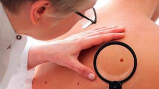 Liga Contra el Cáncer realiza campaña de despistajes contra el cáncer de piel 