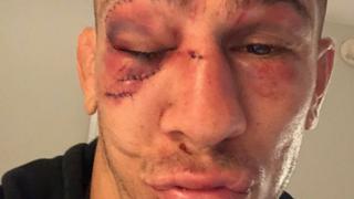 ¡Impresionante! Así quedó el ojo de Niko Price tras su derrota en el UFC 249 [VIDEO]