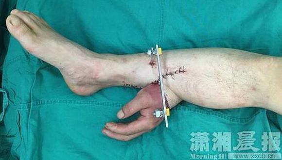 Cirujanos optaron por colocar la mano del paciente en su tobillo por un mes. (xxcb.cn)