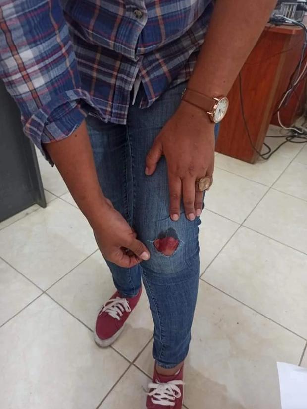 Injuries of the victim after being dragged by the vehicle of the former executive director of decentralized Provías. 
