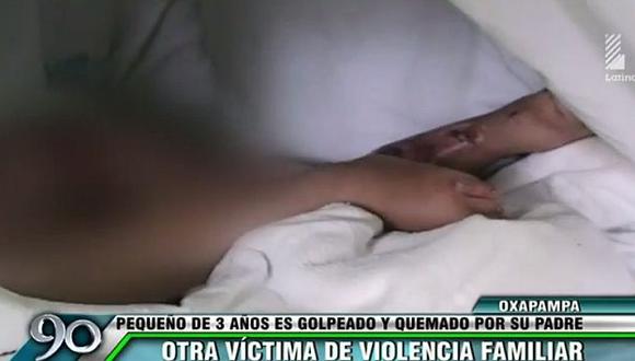 Un menor de tres años fue golpeado y quemado por su padre en Oxapampa. (Latina)