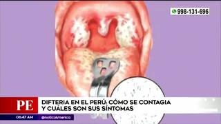Difteria en Perú: conoce cómo se contagia y qué síntomas la caracteriza