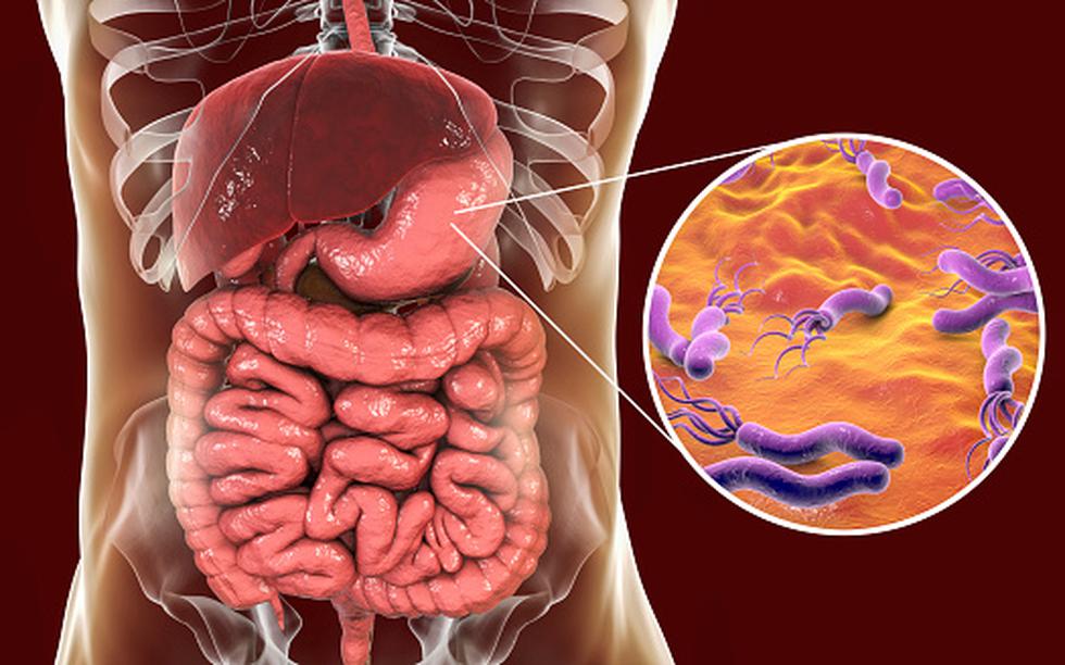 Helicobacter pylori: ¿Cómo se trasmite la bacteria que causa el cáncer de estómago? (Getty)