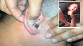 YouTube: Hombre tenía una polilla metida en la oreja