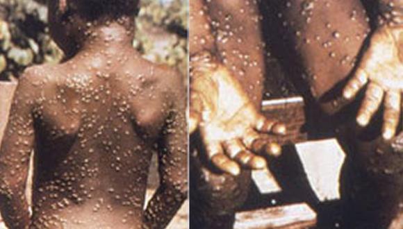 Los primeros casos humanos se identificaron en la República Democrática del Congo en 1970. (Foto: CDC)