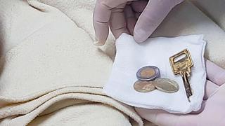 Hombre acude de emergencia a hospital de EsSalud y médicos hallan monedas, una llave y otros objetos en su estómago