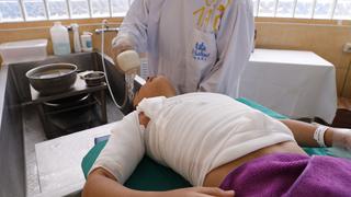 EsSalud: Aumentan en 70% las atenciones por quemaduras en menores durante la pandemia