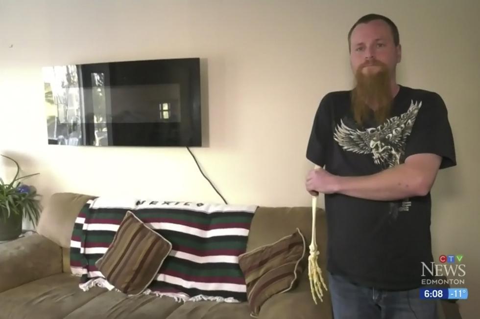 Un hombre en Canadá guardó el esqueleto de su brazo amputado como recuerdo. Su peculiar historia es viral en Facebook. (CTV News)