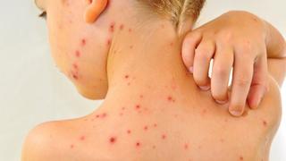 ¡Atención! Estos son los principales signos de alarma de la varicela