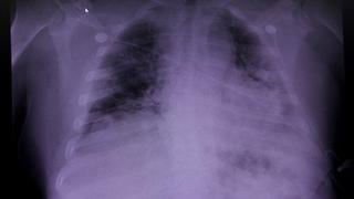 ¿Cuál es la importancia de la ecografía pulmonar en el tratamiento del COVID-19?