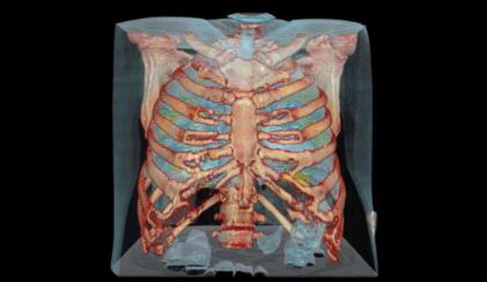 Médicos del Hospital Universitario George Washington utilizaron video de realidad virtual para observar el daño que causa el coronavirus en los pulmones. (Foto: Captura de video)
