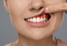 ¡Cuidado! Las enfermedades de las encías pueden provocar pérdida de los dientes