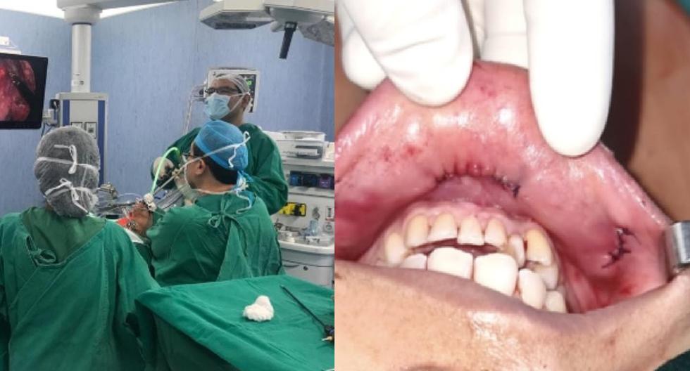 Cirugía de tiroides por la boca sin cicatriz en Perú: ¿En qué consiste
