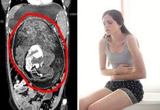 Joven acude al médico por un dolor en el vientre y descubren a su ‘gemelo parásito’