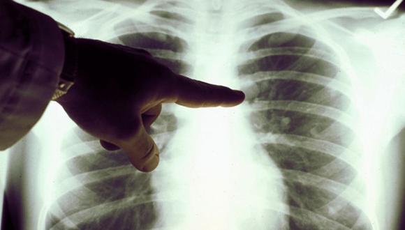 El cáncer de pulmón se ubica entre una de las principales causas de muerte dentro de las variantes del cáncer. (GETTY IMAGES)