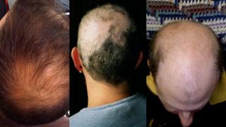 Píldora experimental contra la alopecia logra que el 40% de los pacientes recuperen su cabello