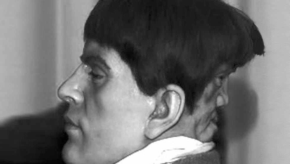 Diprosopia: La verdadera historia del hombre con dos rostros. (Difusión)