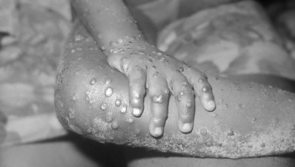 En esta foto del Centro para el Control de Enfermedades de 1971, se muestran lesiones similares a las de la viruela del simio en el brazo y la pierna de una niña en Bondua, Liberia. (Foto: CDC/Getty Images)
