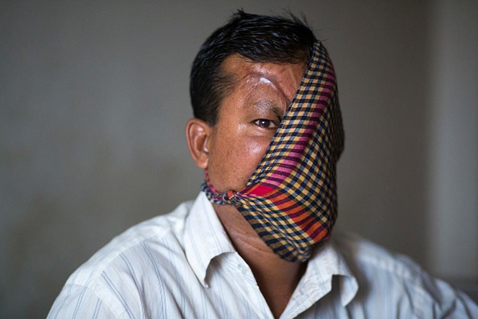 Bangladesh: Hombre atacado en la cara por tigre muestra por primera vez sus heridas. (Getty images)