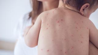 ¿Qué sabemos sobre la varicela?