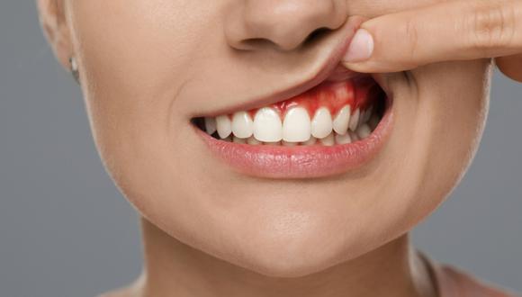 Se calcula que la periodontitis grave, es una de las causas principales de la pérdida dental total.