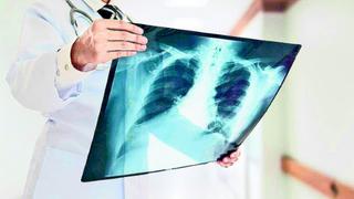 El cáncer de pulmón, el enemigo silencioso que amenaza la salud