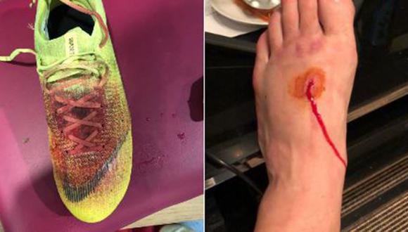 Jugador del West Ham, el español Lucas Pérez, mostró la gran herida en su pie y su botín manchado de sangre. (Foto: @LP10oficial)