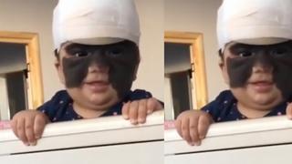 Luna, la famosa ‘bebé Batman’ que recibe tratamiento contra extraña lesión cutánea el rostro