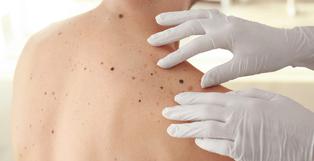 ¿Sabías que el cáncer de piel más agresivo y letal también es el más prevenible? Conoce cómo detectarlo