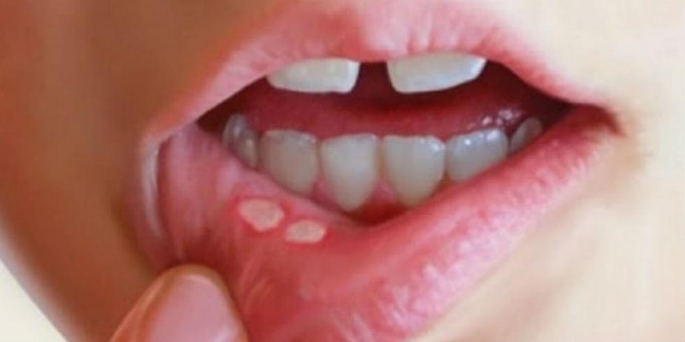 Las aftas bucales son pequeñas úlceras de color blanquecino que se forman en la parte interna de las mejillas, el paladar o la lengua.
(Foto: Difusión)