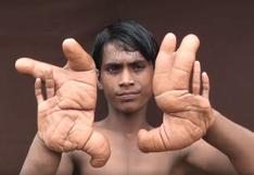 Niño sufre rara condición que volvió gigantes sus manos y pide ayuda [VIDEO y FOTOS]