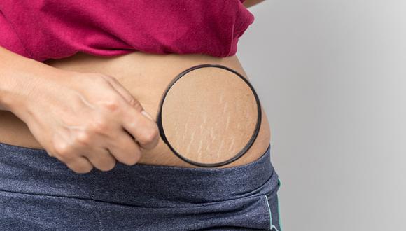 Las estrías son alteraciones benignas de la piel, ubicadas específicamente en la dermis, una de las capas más profundas.  (Foto: Shutterstock)