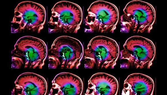 Investigadores descubren un gen que envejece el Cerebro (Getty Images)