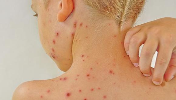 Conoce las medidas de higiene en caso de que tu pequeño se contagie con varicela. (Foto: iStock)
