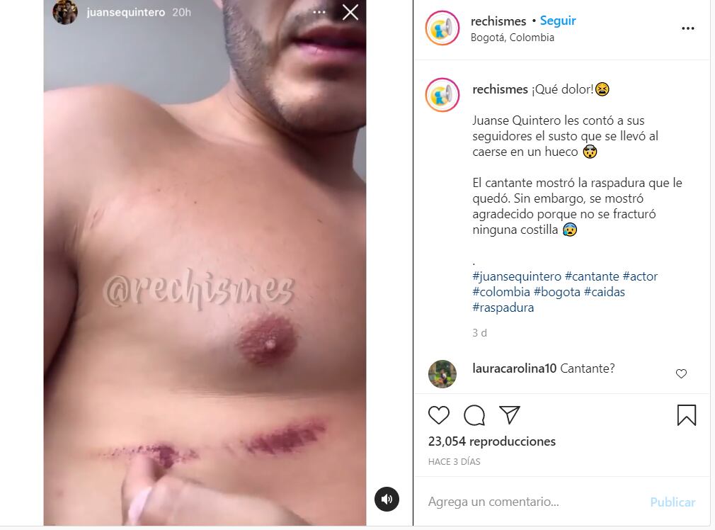 Juanse Quintero mostró su herida en Instagram (Foto: Instagram)