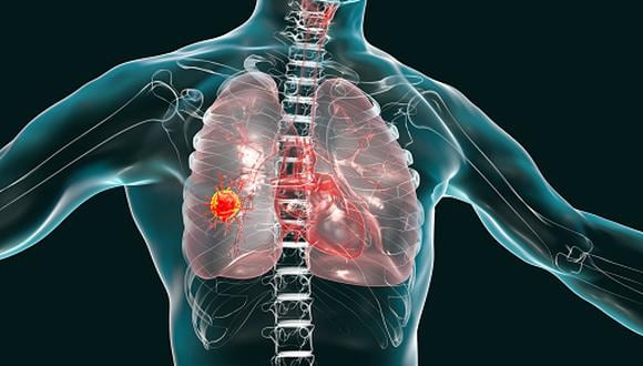 La especialista alertó que el cáncer al pulmón es asintomático en un 80% de los casos y si se presenta síntomas es porque el cáncer está en una etapa avanzada. (Foto: Kateryna Kon / Science photo libra)
