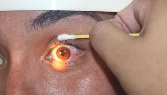 La conjuntivitis se caracteriza por el enrojecimiento de los ojos con ardor o picazón. (Difusión)