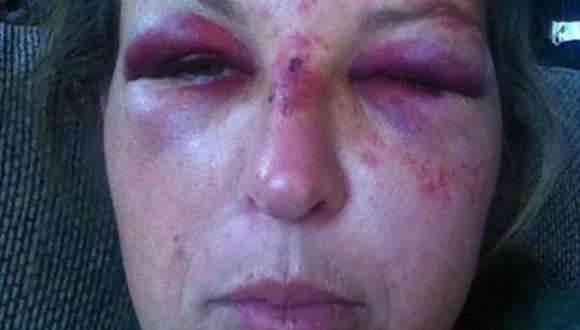 Fue golpeada con una pala en el rostro por proteger a los menores en Estados Unidos (AP)