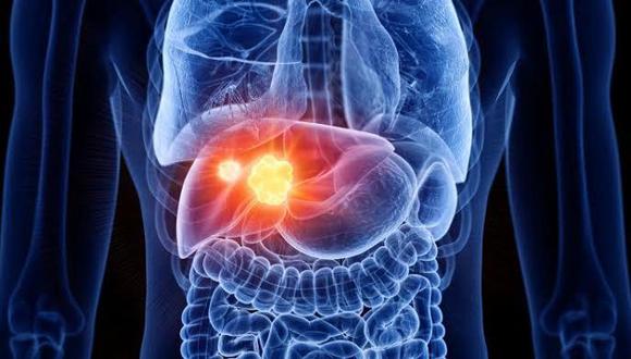 El carcinoma hepatocelular (CHC) ocupa el tercer lugar en incidencia entre los tumores del sistema digestivo en el Perú y presenta una tasa de mortalidad alarmante.