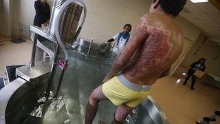 Cultivo de piel humana en laboratorio salvó la vida de 5 niños con 80% del cuerpo quemado