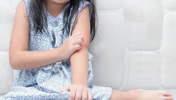 Según la especialista, el 45% de los pacientes con dermatitis atópica inicia su enfermedad en los primeros 6 meses de vida.