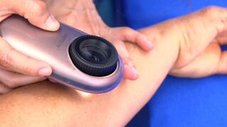 EsSalud: Registran cerca de 6 mil casos de melanoma y otros tumores a la piel en los últimos dos años
