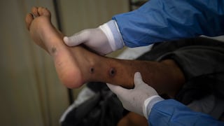 Más de 30 contagios de la ‘viruela del mono’ y Lima es la más afectada